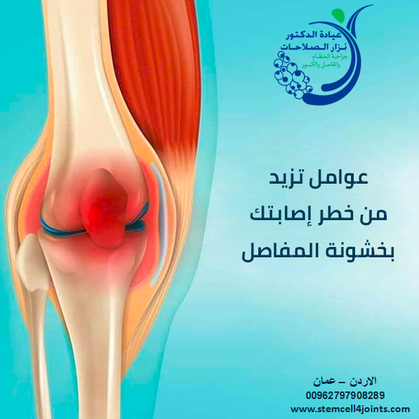 خشونة المفاصل - الدكتور نزار الصلاحات